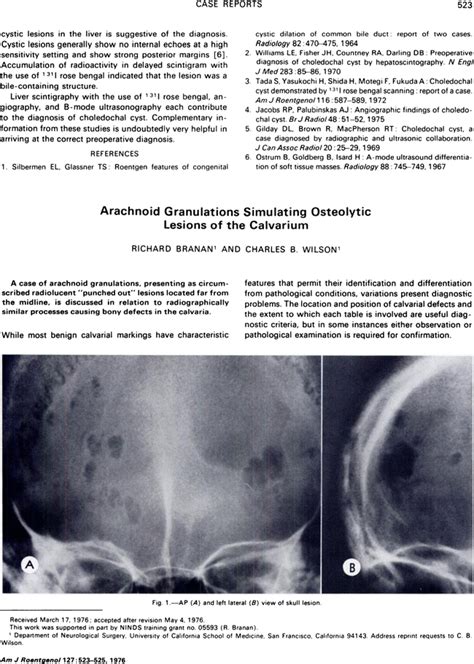 Arachnoid Granulations Simulating Osteolytic Lesions Of The Calvarium Ajr