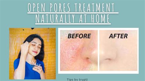 Open Pores Treatment Naturaly At Home In Just 2 Ingredients 🌼 Youtube