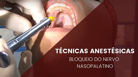 T Cnicas Anest Sicas Bloqueio Do Nervo Nasopalatino Youtube