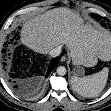 Liver Surgery Important Considerations For Pre And Postoperative