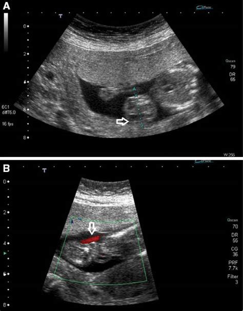 Prenatal Diagnosis Of Fetal Umbilical Cord Teratoma