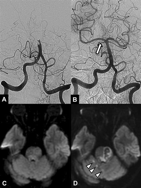 A 64 Year Old Female Patient With Acute Stroke Due To Basilar Artery