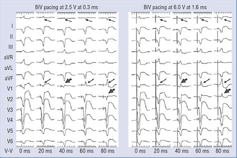 Cardiac Resynchronization Therapy Ecg