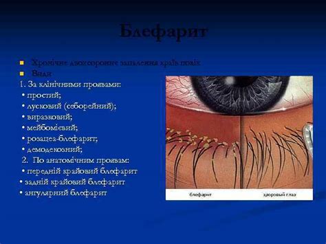 Захворювання повік Демодекозний блефарит Захворювання повік 1