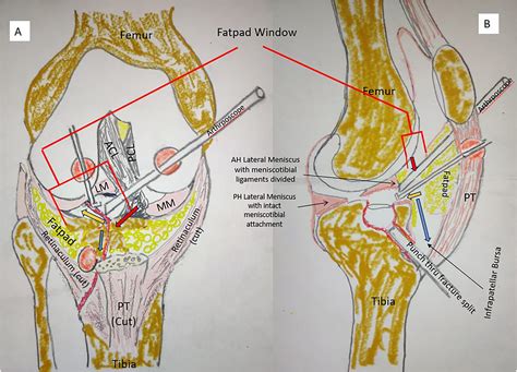 Arthroscopy Strategy To Obtain Surgical Access To Peripheral Lateral