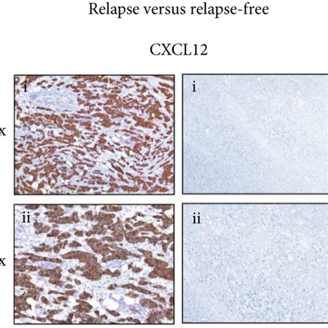 Immunohistochemical Staining For Cxcr4 Vimentin And Cd163 Positive Download Scientific