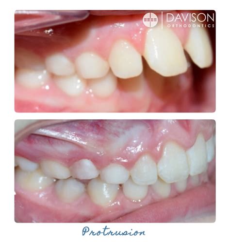 Early Prevention Davison Orthodontics