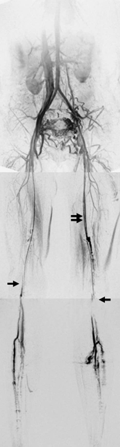 Coronal D Contrast Enhanced Mr Venogram Of Lower Extremities