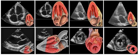 Tte Transthoracic Echocardiogram Sifsof Ca