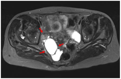 Clinics And Practice Free Full Text Primary Fallopian Tube Carcinoma An Extremely Rare