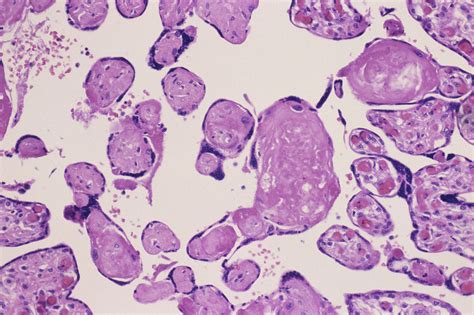 Fetal Thrombotic Vasculopathy Surgical Pathology Clinics