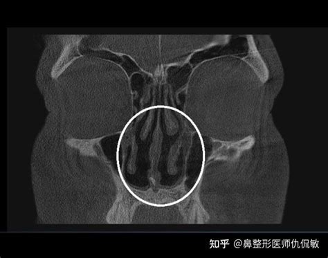 鼻修复 塌鼻手术方法（鼻中隔重建的手术方法） 知乎