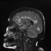 Dawson fingers | Radiology Reference Article | Radiopaedia.org