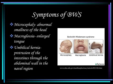 PPT - p57: Beckwith-Wiedemann Syndrome PowerPoint Presentation, free ...