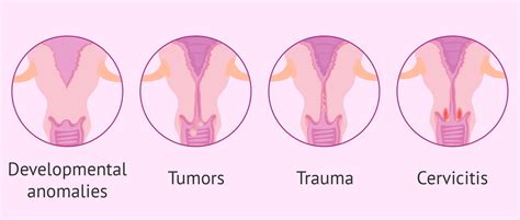 What is cervicitis? - Symptoms, diagnosis and treatment