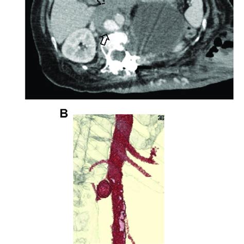 Postoperative Computed Tomography Angiography Indicating A Thrombosed