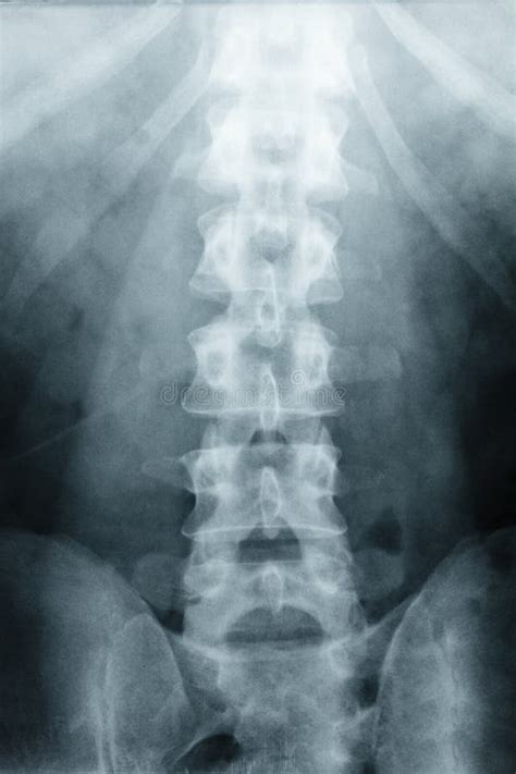 摄制x 射线腰脊柱， L S脊椎ap， L5 S1侧向看法等级spondylolithesis，椎间盘空间decresed高度 库存照片