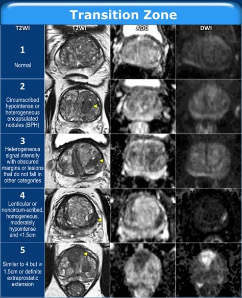 The Radiology Assistant Prostate Cancer PI RADS V2