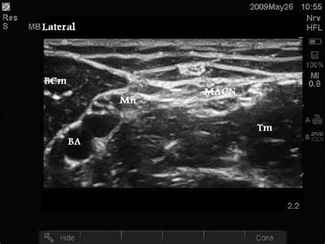 Lateral Antebrachial Cutaneous Nerve Anatomy