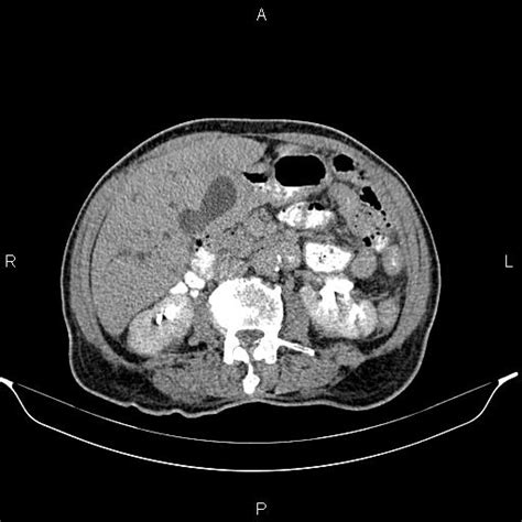 Locally Advanced Gallbladder Adenocarcinoma Image Radiopaedia Org