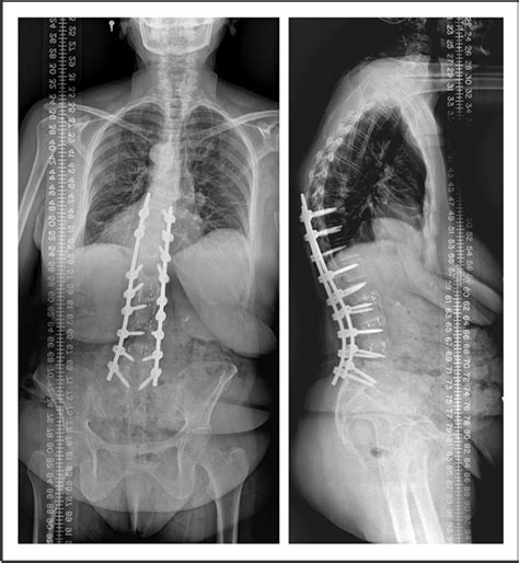 Figure 2 From Lateral Lumbar Interbody Fusion With Rhbmp 2 Can Achieve