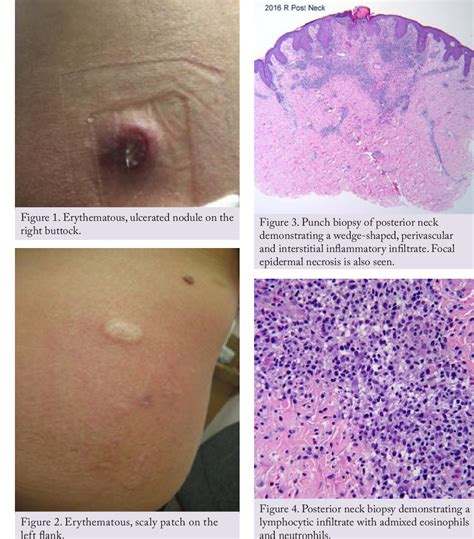 Figure From Co Occurrence Of Lymphomatoid Papulosis And Mycosis