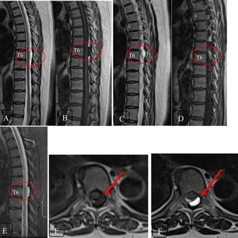 Magnetic resonance imaging showing facet cyst at t6 level in... | Download Scientific Diagram