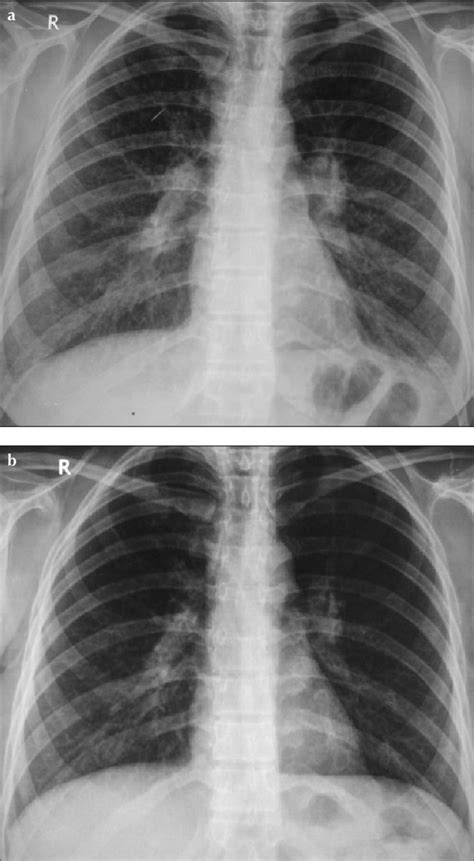 Simple Pulmonary Eosinophilia Case A Chest Radiography At Diagnosis