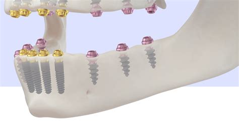 Compressive M Dental Implants Course Trate Dental Implants