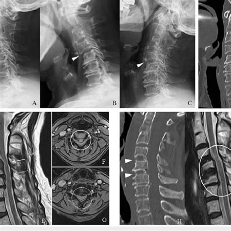 Pre And Postoperative Cervical Imaging Examinations A G Preoperative