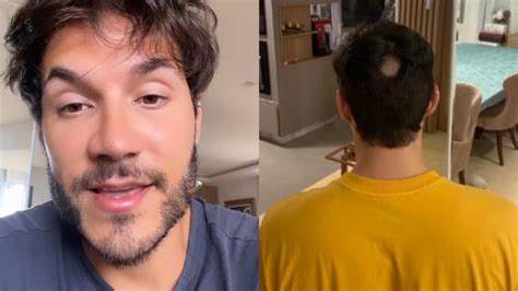 Eliezer revela que desenvolveu alopecia após sofrer ataques na internet