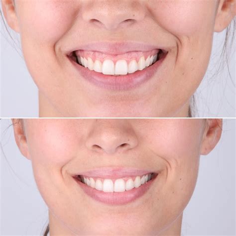 Sorriso Gengival Clinica De Estetica Botox Dentário