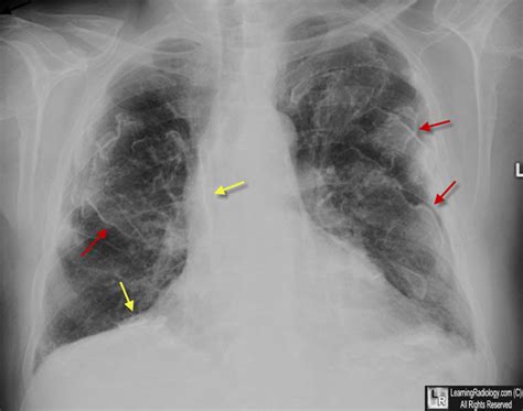 Learning Radiology Asbestos Related Pleural Disease Asbestosis