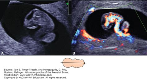 Fetal Cerebral Circulation Radiology Key