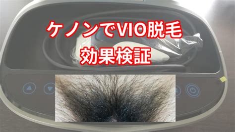 ケノンでvio脱毛の効果はあるの？実際の写真付きレビュー体験談【目指せハイジ男子】 かおるは考えた