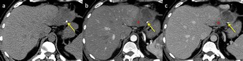 Amoebic Abscess Unenhanced A And Dynamic Contrast Enhanced Ct Images Download Scientific