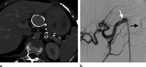 A Axial Ct Angiogram Shows A Large Proximal Splenic Artery Aneurysm Download Scientific