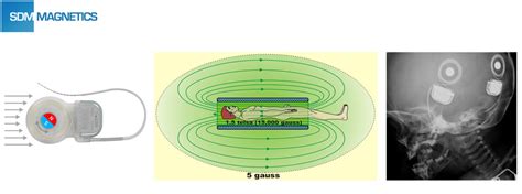 Cochlear Implant Magnet Supplier SDM Magnetics Co Ltd