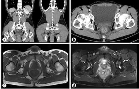 Coronal A And Axial B Contrastenhanced Abdominopelvic Ct Images And