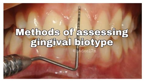 Methods Of Assessing Gingival Biotype Dentalbyhadeel Thread From