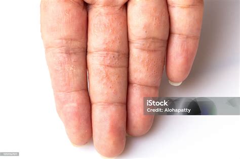 Close Up Atopic Dermatitis On Finger Also Known As Atopic Eczemaskin