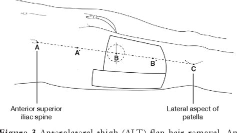 Laser Hair Removal For Genital Gender Affirming Surgery Semantic Scholar