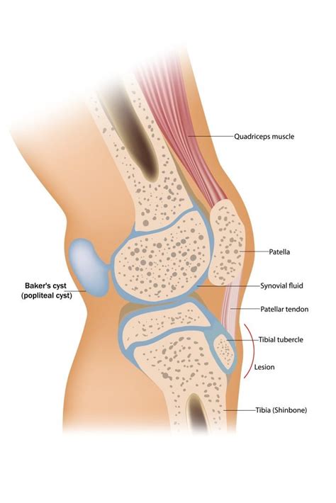 Popliteal Cysts Physioflow PT Physical Therapy Vancouver WA