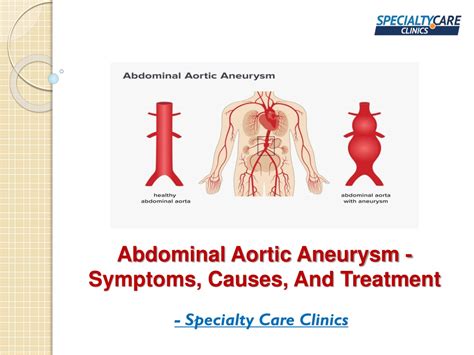 Ppt Abdominal Aortic Aneurysm Symptoms And Causes Powerpoint Hot Sex Picture