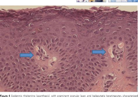 Figure From Epidermodysplasia Verruciformis Symptoms Causes