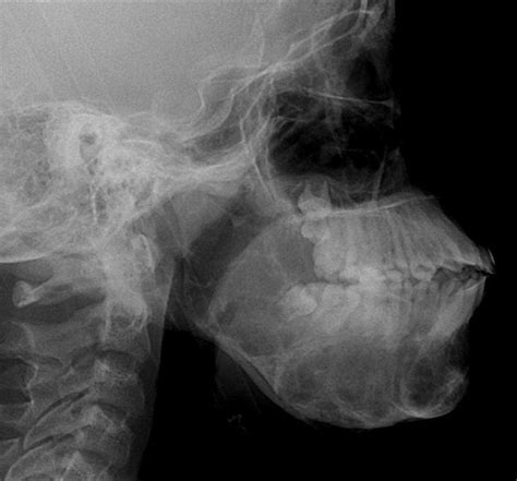 Of Ultrasonography In Maxillofacial Intraoral Benign And Malignant