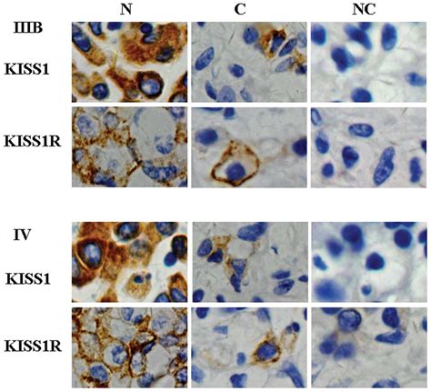 Expression Of Kiss1 And Kiss1r Gpr54 May Be Used As Favorable