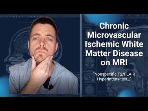 a man with his hand on his chin and the words chronic microvascular ischemic white matter ...