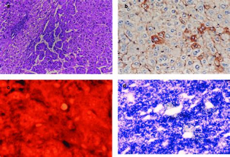 Microscopic Appearance Of Hepatocellular Carcinoma Hcc A D A An Download Scientific