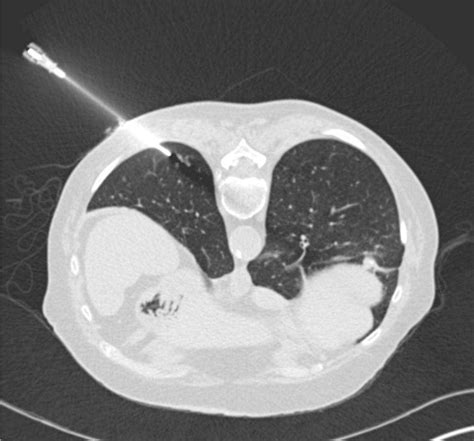 Image Guided Lung Biopsy Lung Cancer